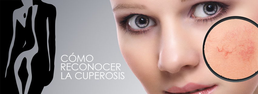 Cómo reconocer la cuperosis