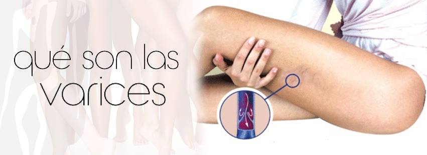 Las varices